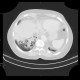 Bronchiectasia, cystic bronchiectasia: CT - Computed tomography